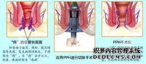 痔疮会自愈吗